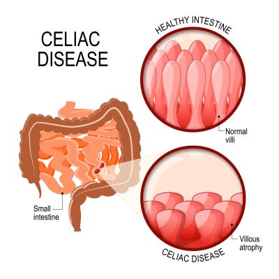 TAK-062-2001 Treatment of Active Celiac Disease in Subjects Attempting a Gl